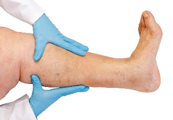 NanoVein is used to treat varicose veins, thrombosis, comorbidities