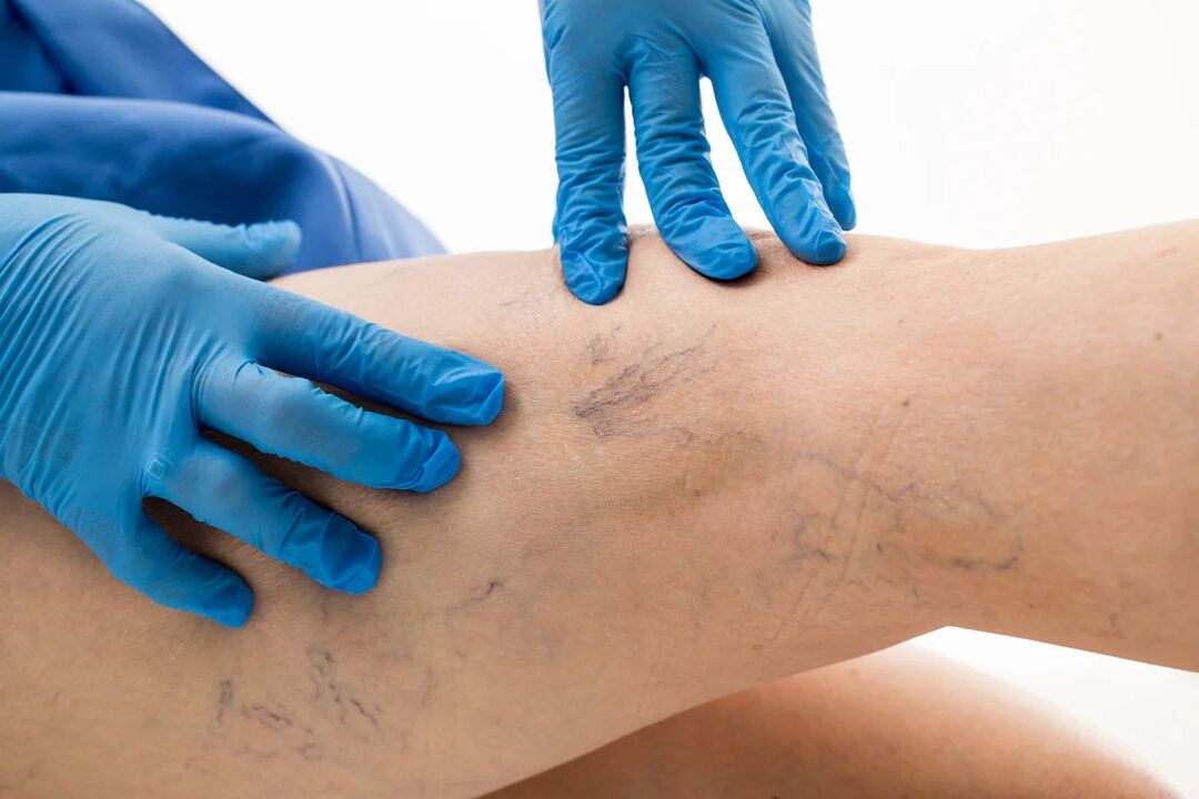 Net varicosis