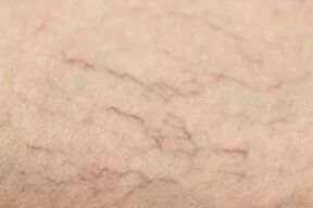 Vascular stars