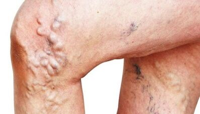 The main manifestations of varicose veins on the legs