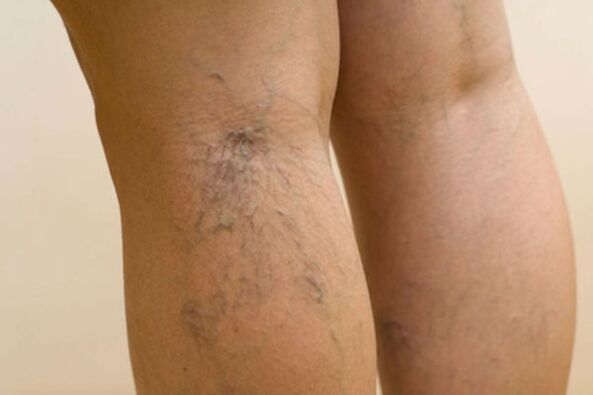 varicose veins in women's legs
