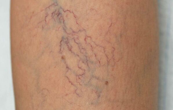 varicose veins on the legs in women