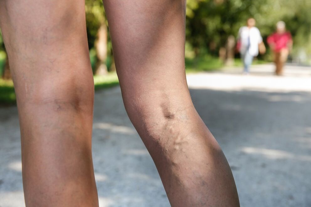 varicose veins on the legs