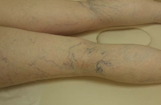 Varicosis Stars on the legs