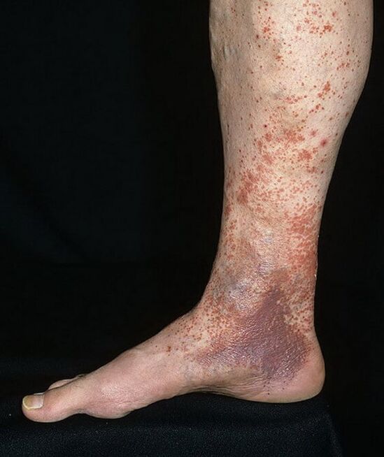 Varicus dermatitis