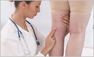 Woman saw doctor with obvious signs of varicose veins