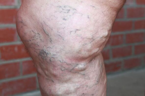 Signs of varicose veins