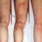 Leg varicose veins
