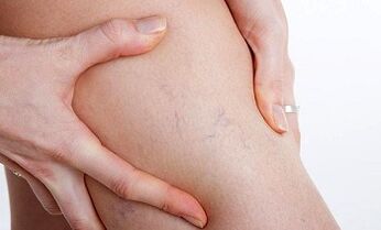 reasons for the development of varicose veins in the legs