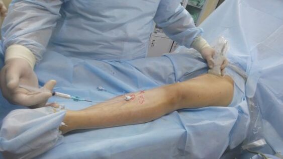 varicose vein surgery on the legs