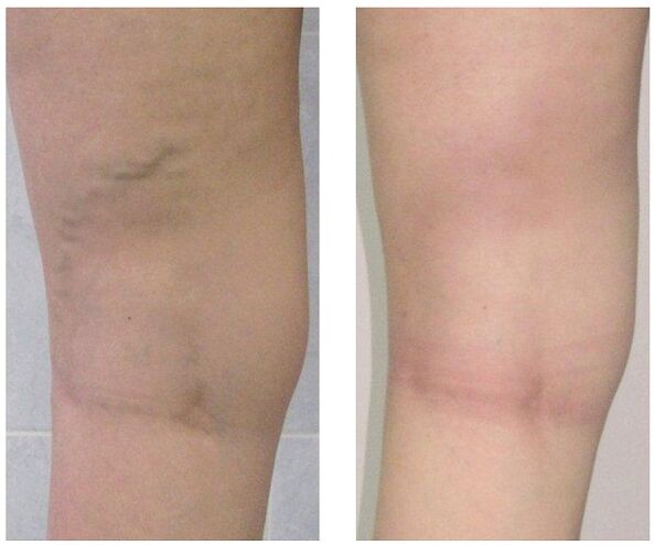 vein in the leg before and after treatment for varicose veins