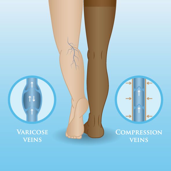 Effects of compression garments on varicose veins in the legs