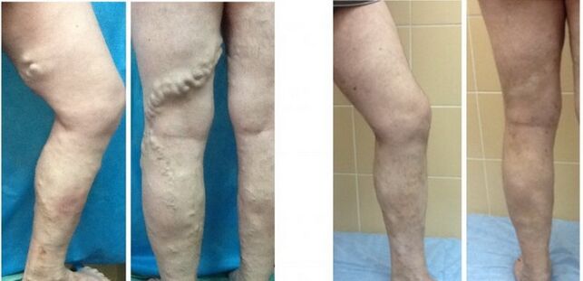 Legs before and after radiofrequency obliteration of veins with varicose veins