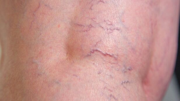 Signs of reticular varicose veins of the lower limbs - dilation of fine veins and vascular mesh