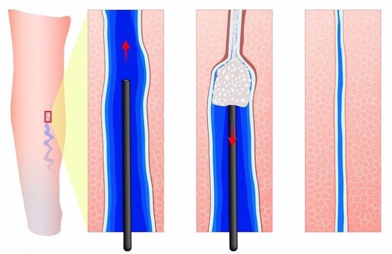 sclerotherapy of varicose veins of the legs in men