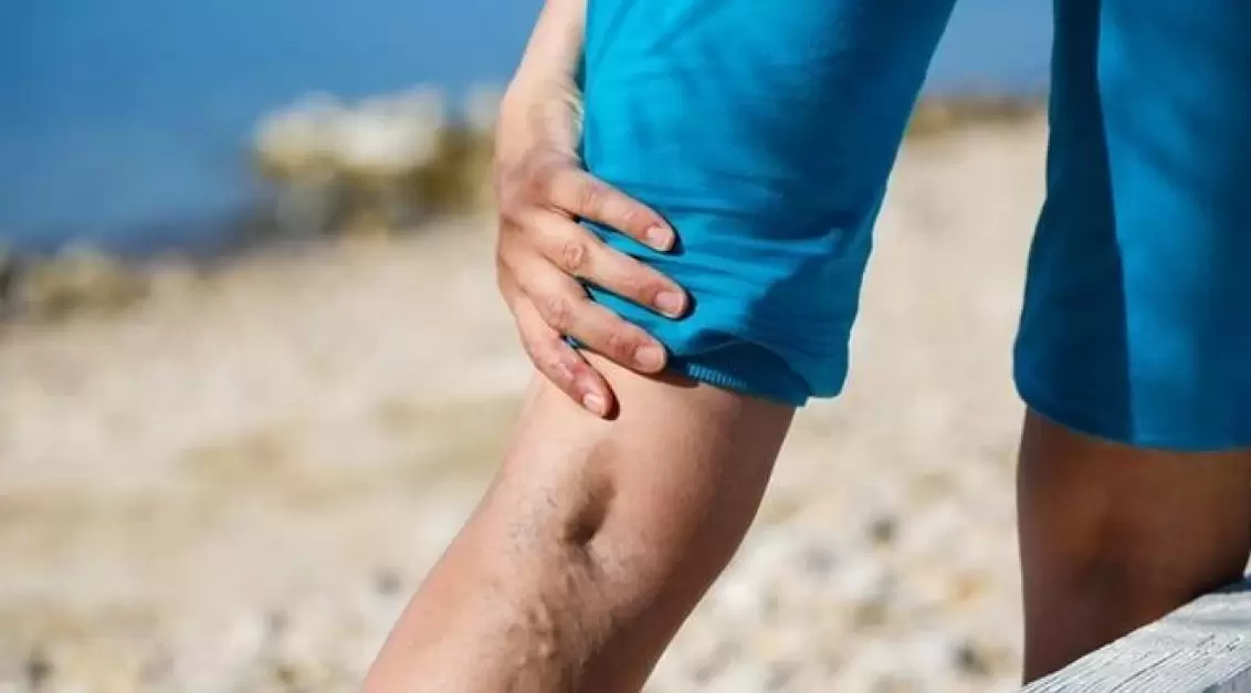 Blue bulging veins on the legs are a sign of varicose veins