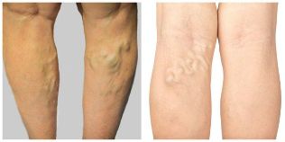 large varicose veins on the legs